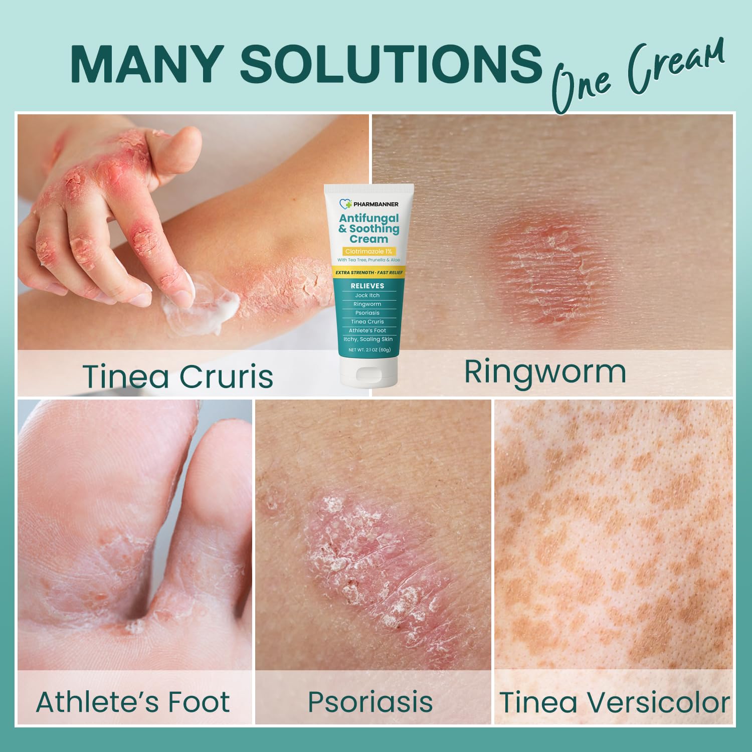 Antifungal Cream for Jock Itch, Ringworm, Psoriasis & Athlete’s Foot