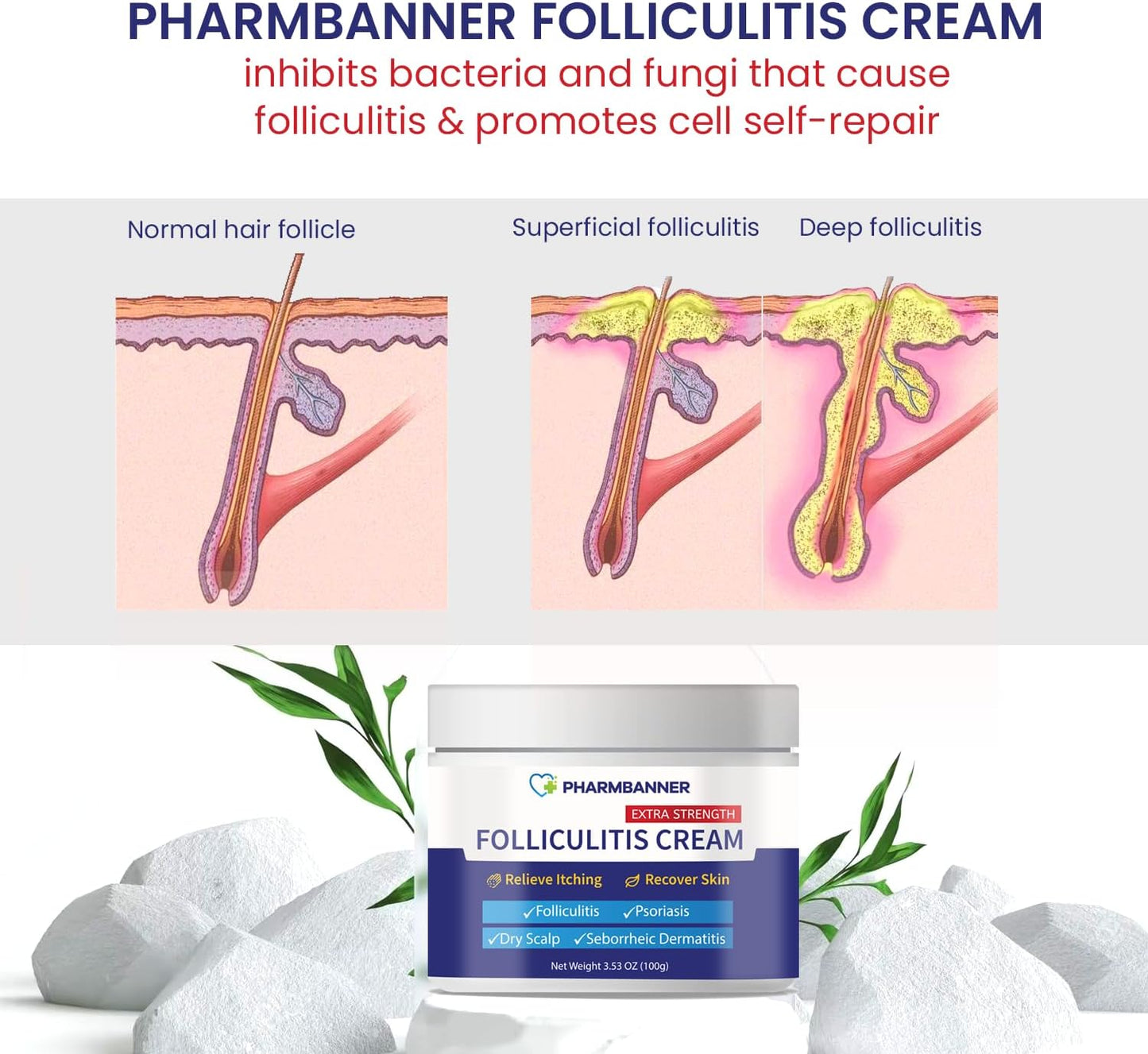 Folliculitis Treatment Cream, Extra Strength Folliculitis Scalp Treatment, Antifungal Cream, Psoriasis Cream, Fast Effective Treatment for Folliculitis, Psoriasis & Seborrheic Dermatitis,Itch Relief